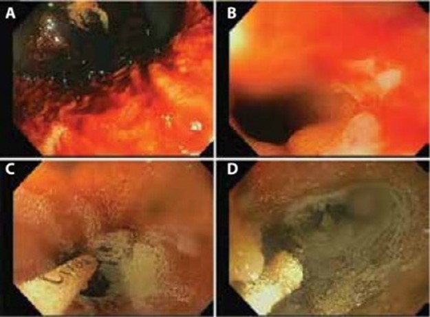 Diffuse bleeding treated with hemostatic powder