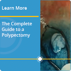 Link to Complete Guide to a Polypectomy