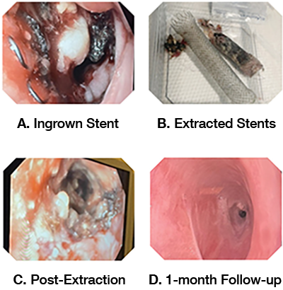 Ingrown Stents